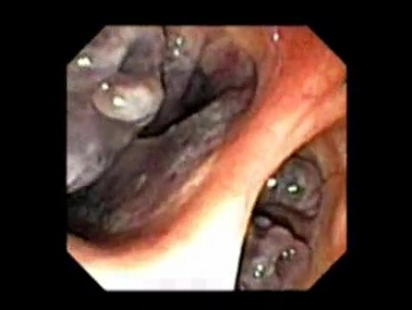 Nasopharynx (10 of 32)