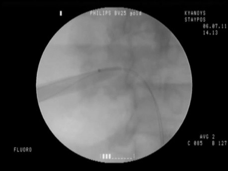 Retrograde Intrarenal Surgery - Percutaneous Nephrolithotomy