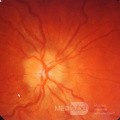 Endoscopic Third Ventriculostomy in a Benign Case of Aicardi Syndrome with Obstructive Hydrocephalus and Chiari Malformation type 1