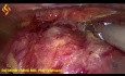 Thoraco-Lap Esophagectomy - Thoracic Part 1
