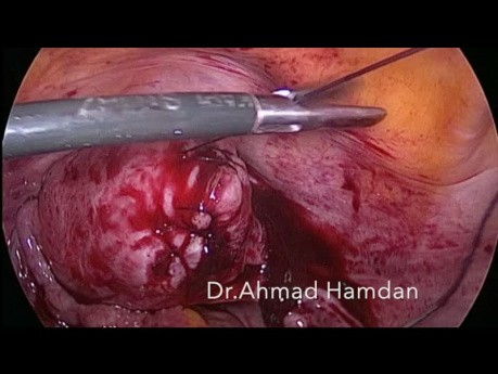 Laparoscopic Myomectomy