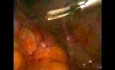 Laparoscopic Oesophago-coloplasty