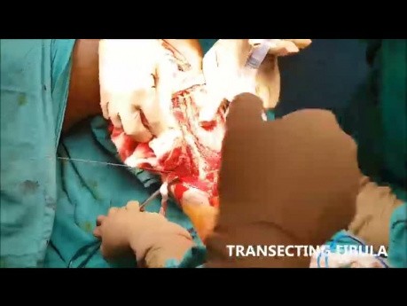 Excision of Head of Fibula for Ewing Sarcoma