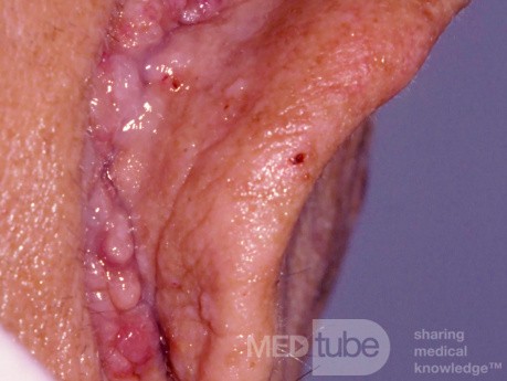 Primary Cutaneous Amyloid