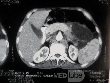 Pancreas cancer - 3