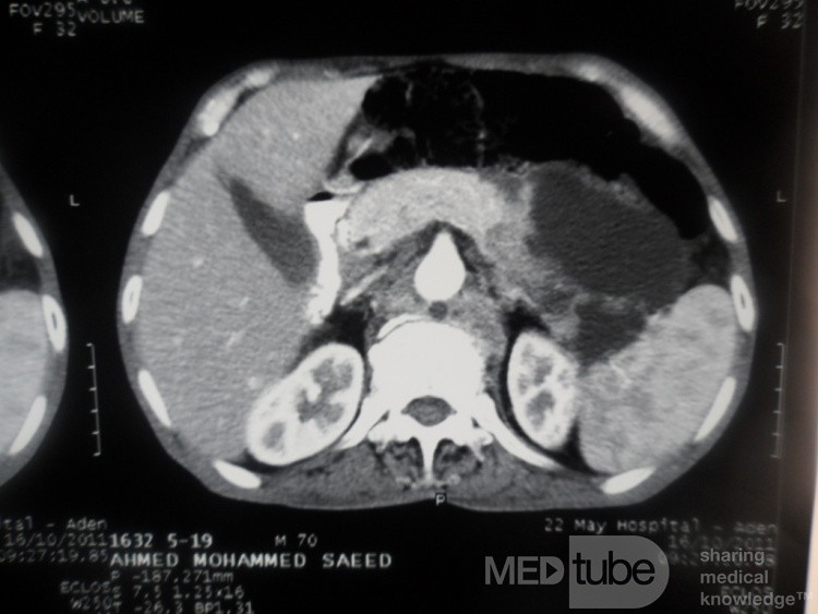 Pancreas cancer - 3