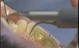 Ultrasonic Tooth Cleaning