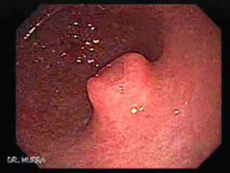 Eosinophilic Esophagitis - Ectopic Pancreas - 2/3