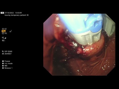 Transoral Incisionless Fundoplication (TIF)