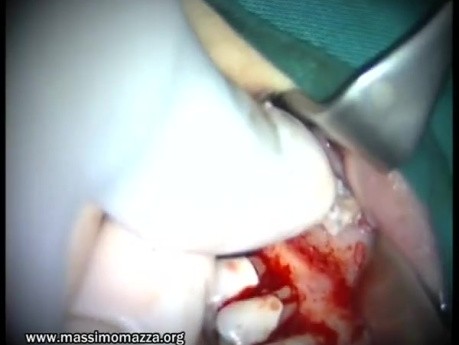 Sinus Lifting (2/2)