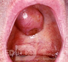Pleomorphic Adenoma"Palate"