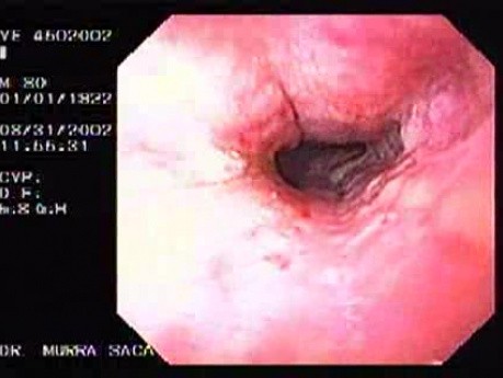 Hemorrhagic Esophagitis Due To Alcoholism - Retraction Of The Endoscope