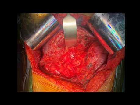 Case Report: Right Hemihepatectomy En-bloc with Caudate Lobectomy for Klatskin Bismuth Type 3a in a Patient with Right Portal Vein Thrombosis and Right Hemiliver Inflammatory Pseudotumors