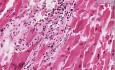 Toxoplasma gondii myocarditis