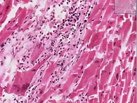 Toxoplasma gondii myocarditis