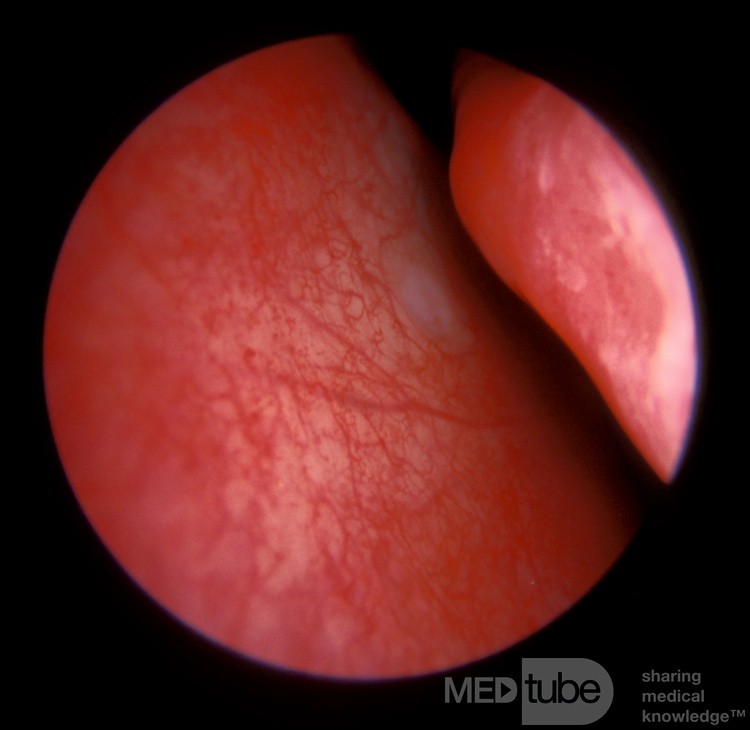 Little's Area Of The Anterior Nasal Septum