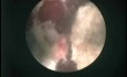 Percutaneous Nephrolithotomy - Infectious Stone