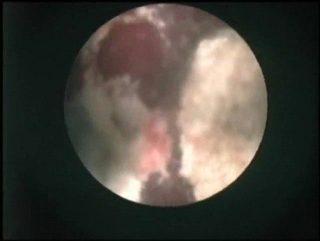 Percutaneous Nephrolithotomy - Infectious Stone