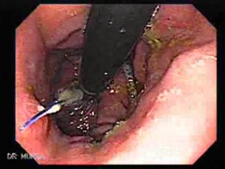 Intraluminal Endoscopic Suturing - Follow Up One Year After Procedure, Retroflexed View