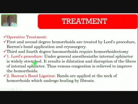 Hemorrhoids - Lower GI Hemorrhage