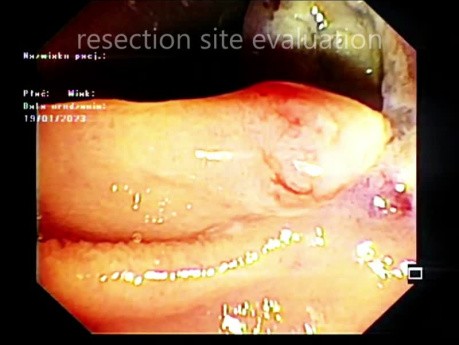 Ampullectomy (part 1)