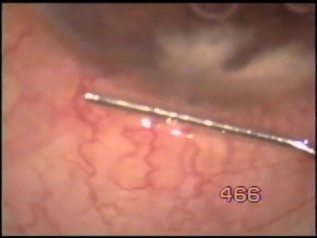 Pseudophakic Eye With Glaucoma - Microtrack Filtration
