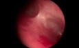 Tracheovascular Fistula in a 1.5-Year-Old Infant Presenting with Recurrent Lower Respiratory Infections