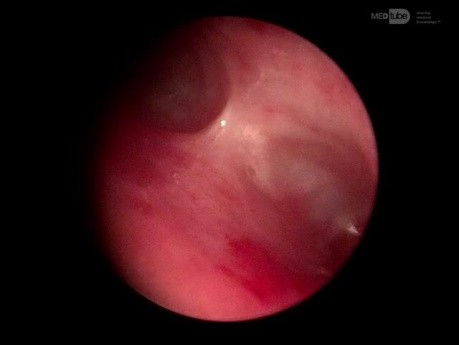 Tracheovascular Fistula in a 1.5-Year-Old Infant Presenting with Recurrent Lower Respiratory Infections