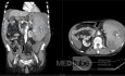 Splenic Rupture