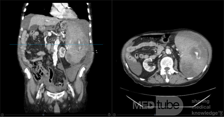 Splenic Rupture