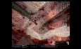 Inan Modification TRAPPIST Repair for Bricker Ileal Conduit Urostomy Parastomal Hernia Repair (PSH)