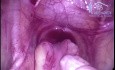 Undescended Testes Laparoscopic Management; The Sad Scenario