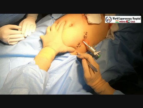 Ruptured Ectopic Pregnancy