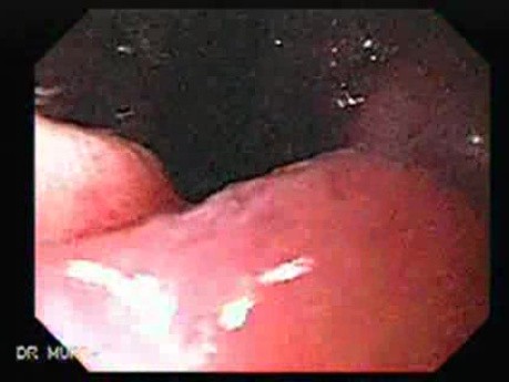 Gastric Cancer - Endoscopy (7 of 15)
