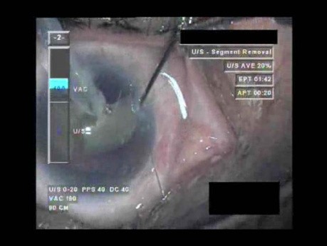 Cataract Surgery IX - Part 3
