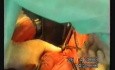 Gastric Cancer Surgery
