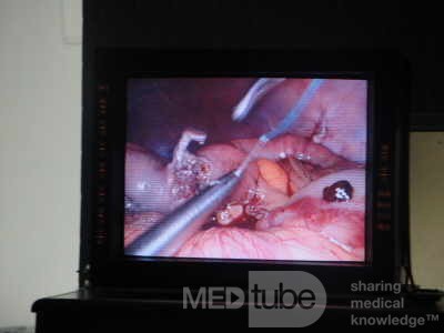 Gastric Ulcerated Adenocarcinoma of the Pre-pyloric Antrum (9 of 28)