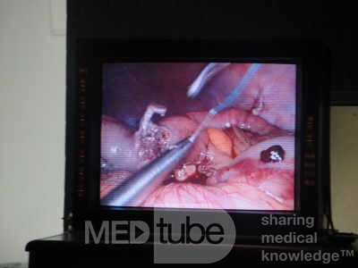 Gastric Ulcerated Adenocarcinoma of the Pre-pyloric Antrum (9 of 28)