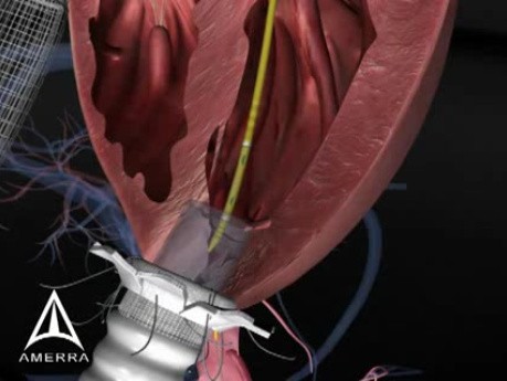 Amerra's Use of Zygote Systems - 3D Medical Animation 
