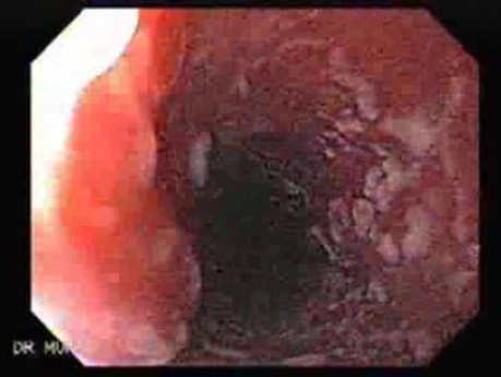 Candidiasis - Endoscopic Assessment