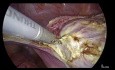 Total Laparoscopic Hysterectomy - Does Size Matter