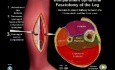Compartment Syndrome - Video Animation