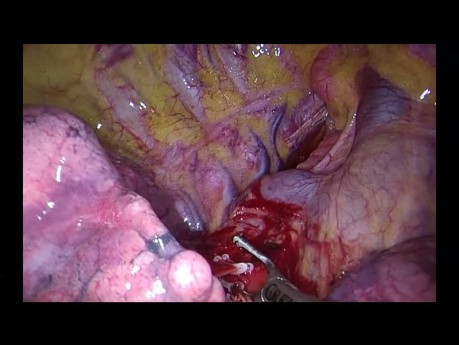 Unisurgeon Uniportal VATS anatomic right apical segmentectomy S1 (NO ASSISTANT)