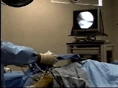 Arthroscopy - Surgery Video