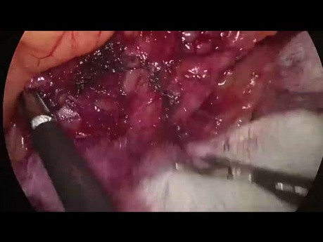 Laparoscopic Sigmoidectomy. Supracolic Splenic Flexure Mobilization (Full Length Video)