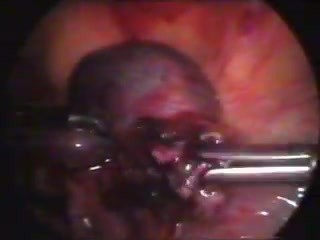 Removal of Ectopic Pregnancy by Laparoscopic Method