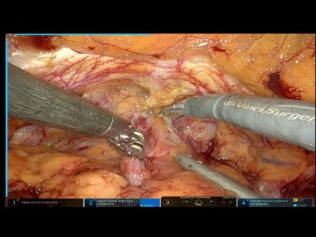 Robotic Radical Prostatectomy Case with Early Trifect Result