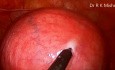 Laparoscopic Myomectomy for Intramural Myoma