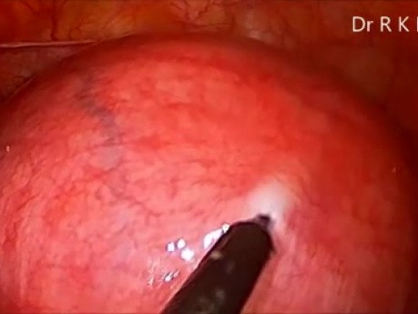 Laparoscopic Myomectomy for Intramural Myoma