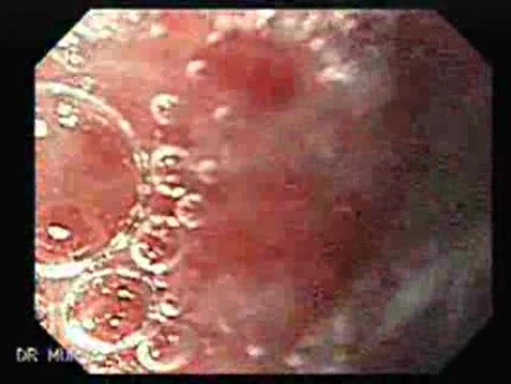 Gastric Varices Rosettes Formation (20 of 22)